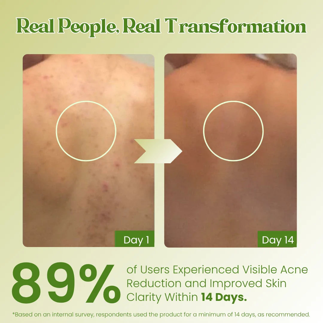 Anti acne soap -100g